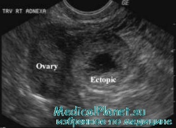 Ultrahang vizsgálat a terhesség korai szakaszában