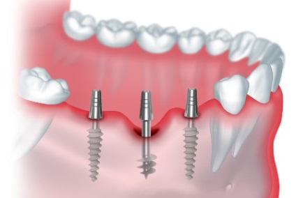 Típusú fogászati ​​implantátumok