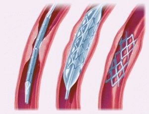 Sebészi kezelése alsó végtag arterioszklerózis módszerek, technikák és eredmények
