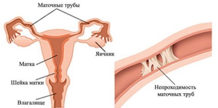 Krónikus endometriosis - mi ez, tünetei és kezelése