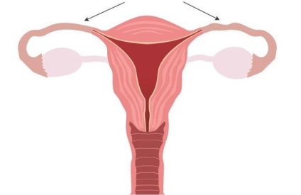 Krónikus endometriosis - mi ez, tünetei és kezelése