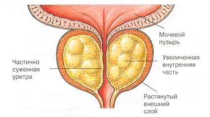 A prosztata libidó gyulladása prostatitis vizelet vérrel a férfiaknál