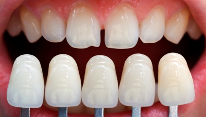 Étel ragadt a fogak közötti okai, következményei, hogy mit és hogyan kell kezelni