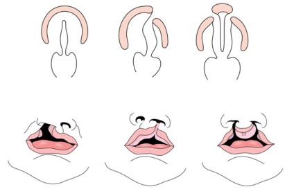 Ajak- szájpadhasadék - patológia szájpadhasadék és az ajkak