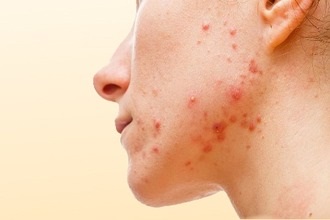 Allergiás a sárgarépa - tünetei és kezelése a gyermek és felnőtt