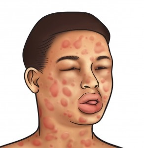 Anafilaxiás sokk elsősegély vagy hogyan nem hal allergiában!