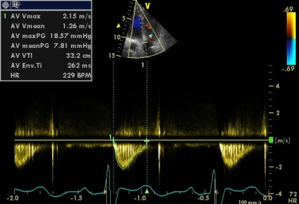 Anny aneurizma ruptúra jobb sinus coronarius Valsalva fistula a hasnyálmirigyben (szünet) Anny aneurizma ruptúra jobb sinus coronarius Valsalva fistula a hasnyálmirigyben