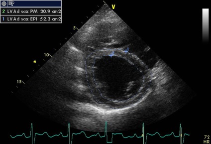 Anny aneurizma ruptúra jobb sinus coronarius Valsalva fistula a hasnyálmirigyben (aneurizma) Anny aneurizma ruptúra jobb sinus coronarius Valsalva fistula a hasnyálmirigyben