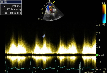 Anny aneurizma ruptúra jobb sinus coronarius Valsalva fistula a hasnyálmirigyben (aneurizma) Anny aneurizma ruptúra jobb sinus coronarius Valsalva fistula a hasnyálmirigyben