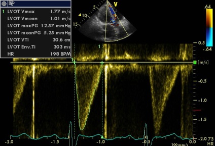 Anny aneurizma ruptúra jobb sinus coronarius Valsalva fistula RV (jobb oldali) Anny aneurizma ruptúra jobb sinus coronarius Valsalva fistula a hasnyálmirigyben