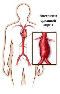 aorta betegségei