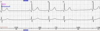 Lelassult, szabálytalan szívműködés sinus gyermekekben, súlyos, közepes, annak kezelése (bradyarrhythmiában) Lelassult, szabálytalan szívműködés sinus gyermekekben, súlyos, közepes, a kezelést