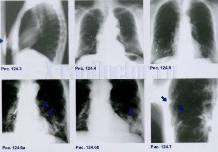 Mit jelent a fehér folt a tüdő röntgen
