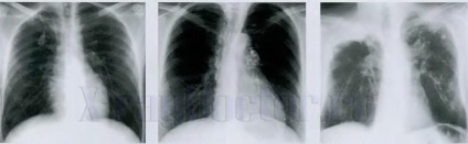 Mit jelent a fehér folt a tüdő röntgen