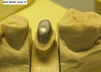 Dental-Revue, cikkek, ortopédiai, felülvizsgálata előállítási módszerek a fogak fémkerámia