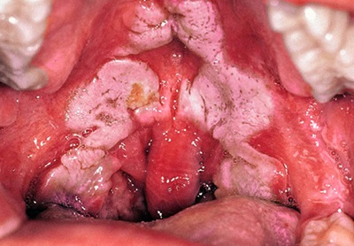 Diftéria kórokozó, járványtan és patogenezise (Corynebacterium diphtheriae Gravis) A diftéria kórokozó, járványtan és patogenezise