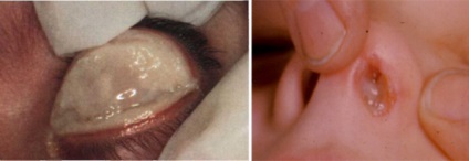 Diftéria kórokozó, járványtan és patogenezise (diftéria Bacillus átviteli út diftéria patogenezisében) A diftéria kórokozó, járványtan és patogenezise