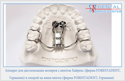 Distalization zápfog (zápfogak distalization. Distalization zápfog orthodontiai helyet.) distalization zápfog