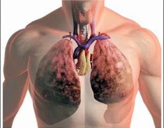 Tüdőtágulás - élet prognózis, gyógyszerek és kezelés