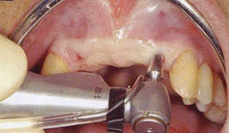 Endoszkóp fogbeültetés eljárás