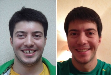 Ezek az emberek, akik határozott időre a görbe fogak segítségével fogszabályozó, és most igazán mosolyogni