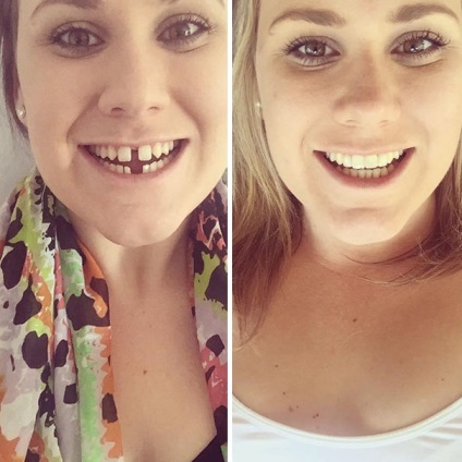 Ezek az emberek, akik határozott időre a görbe fogak segítségével fogszabályozó, és most igazán mosolyogni