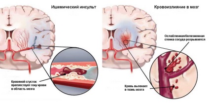 Testmozgás szélütés, hogyan kell elvégezni a megelőzés (terhelés) Fizikai aktivitás stroke után, hogyan kell elvégezni a megelőzés