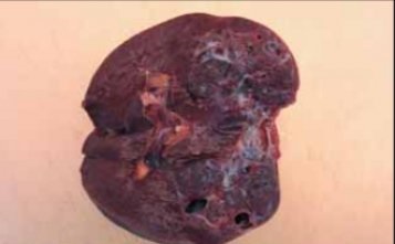 Hemangioma a lép okoz, tünetei és kezelése (okok) Hemangioma a lép okoz, tünetek és a kezelés