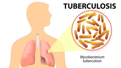 Általános hematogén tuberkulózis, és mit