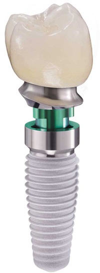 Implantátum vagy implantátum - ez itt a kérdés! (Implantátum) Implantátum vagy implantátum - ez itt a kérdés!