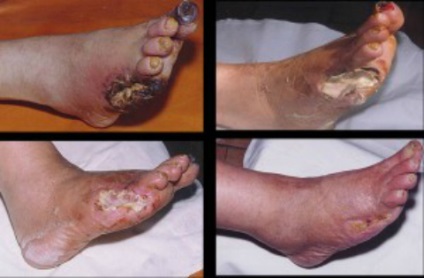 Alsó végtagi ischaemia - tünetek és kezelés (rövid szénláncú) Alsó végtagi ischaemia - tünetek és kezelés