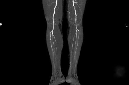 Alsó végtagi ischaemia - tünetek és kezelés (ischaemia) Alsó végtagi ischaemia - tünetek és kezelés