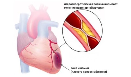 Változások a szívizomban a szív - kifejezni, és a kisebb hegek