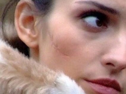 Hogyan, hogy könnyítsen a heg típusú hegek eljárások ezek kezelésére és fehérítő (könnyítsen) Hogyan, hogy könnyítsen a heg típusú hegek eljárások ezek kezelésére és fehérítés