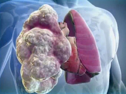 Mi az élet az előrejelzés megadott emphysema a tüdő, a tünetek és kezelések