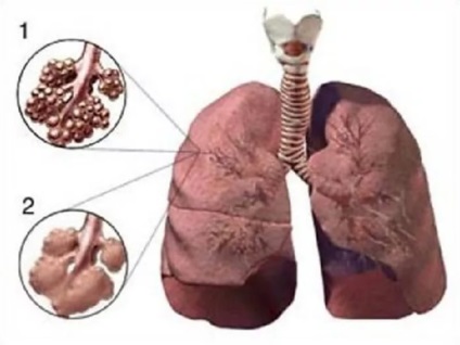 Mi az élet az előrejelzés megadott emphysema a tüdő, a tünetek és kezelések