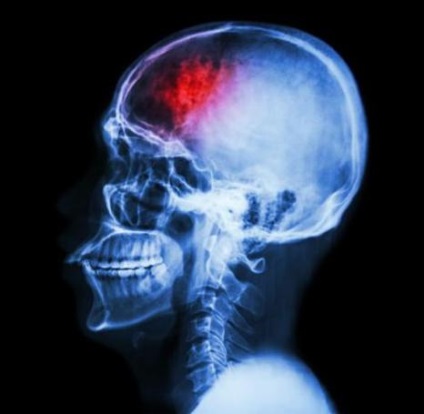 Hogyan ismerjük fel a stroke emberben okoz, szövődmények és stroke kezelésében