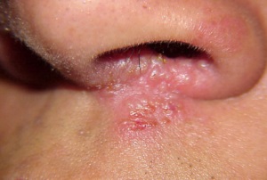 Hogyan lehet gyógyítani herpesz az orrban a gyorsan haza