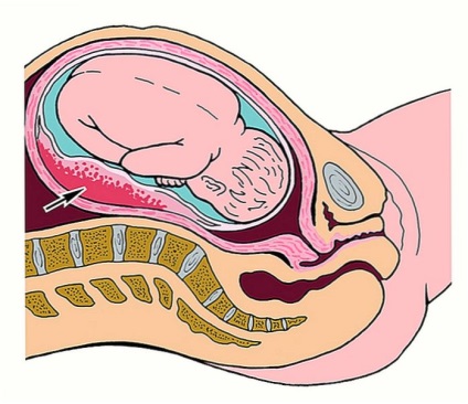 Hogy megy vérömleny a terhesség alatt a korai és késői szakaszában