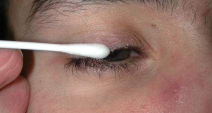 Demodex atkák szemhéj, szempilla, a bőr a szem körül, a kábítószer kezelésére