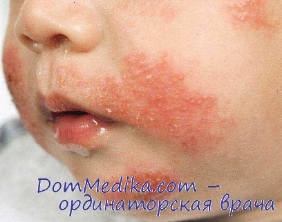 Klinika atópiás dermatitis