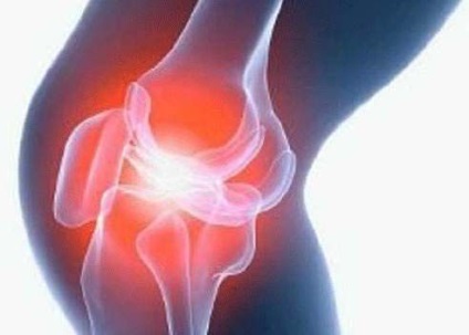 Térdízületi gyulladás (artritisz) típusai és kezelésük