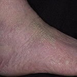 kötőhártya bőr a láb, kéz, arc - okai és kezelése fotó