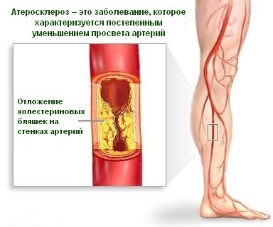 atherosclerosis gyógyszeres terápia