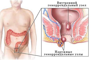 A kezelés aranyér RB, az okok a betegség