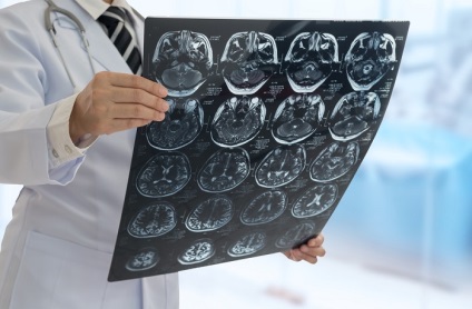 Stroke kezelésére az germánium (germánium) Stroke kezelés Németországban