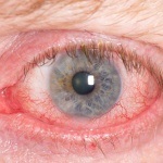 Kezelés - lusta szem - felnőtt módon gyógyító betegségéből
