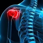Gyógyszeres kezelés merev váll (glenohumeral) Kezelése glenohumeral periarthritis gyógyszert