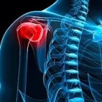 Kezelése glenohumeral periarthritis gyógyszert