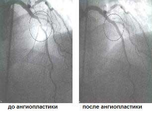 Angina kezelése mechanikus revaszkularizációs